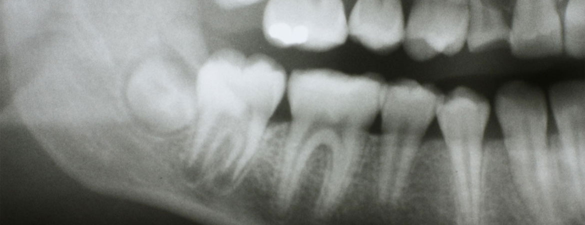 should-you-say-no-to-dental-x-rays
